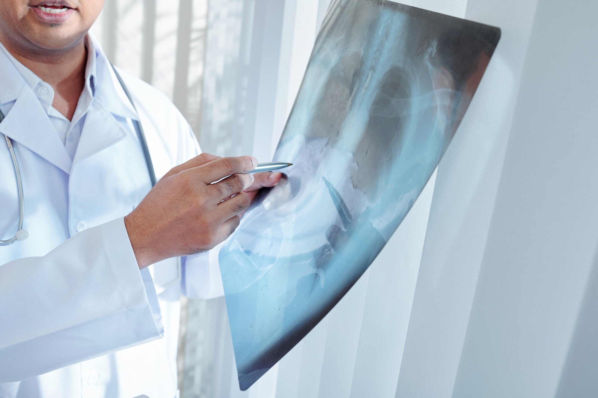 Doctor checking lungs x-ray